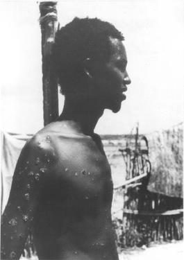 Smallpox Eradication Anniversary